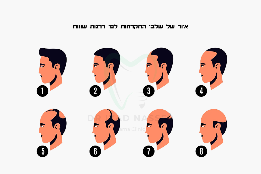 איור של שלבי התקרחות לפי דרגות שונות